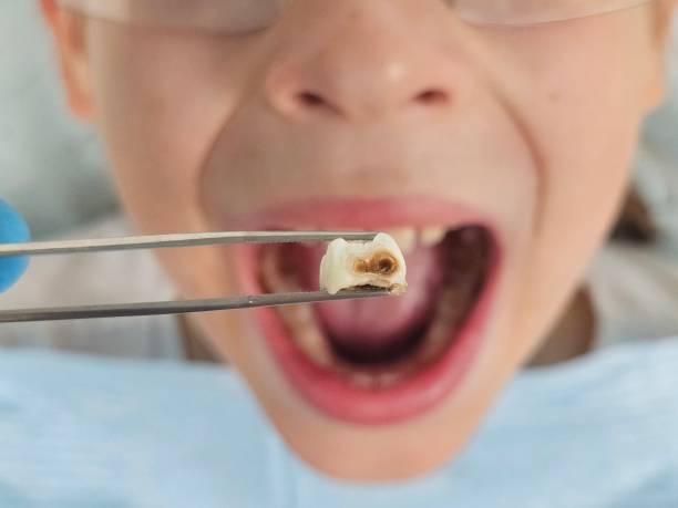 Best Dentist for Tooth Abscess  in Montura, FL