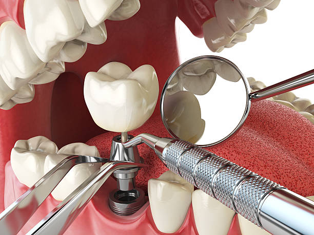 Best Broken Tooth Emergency  in Montura, FL